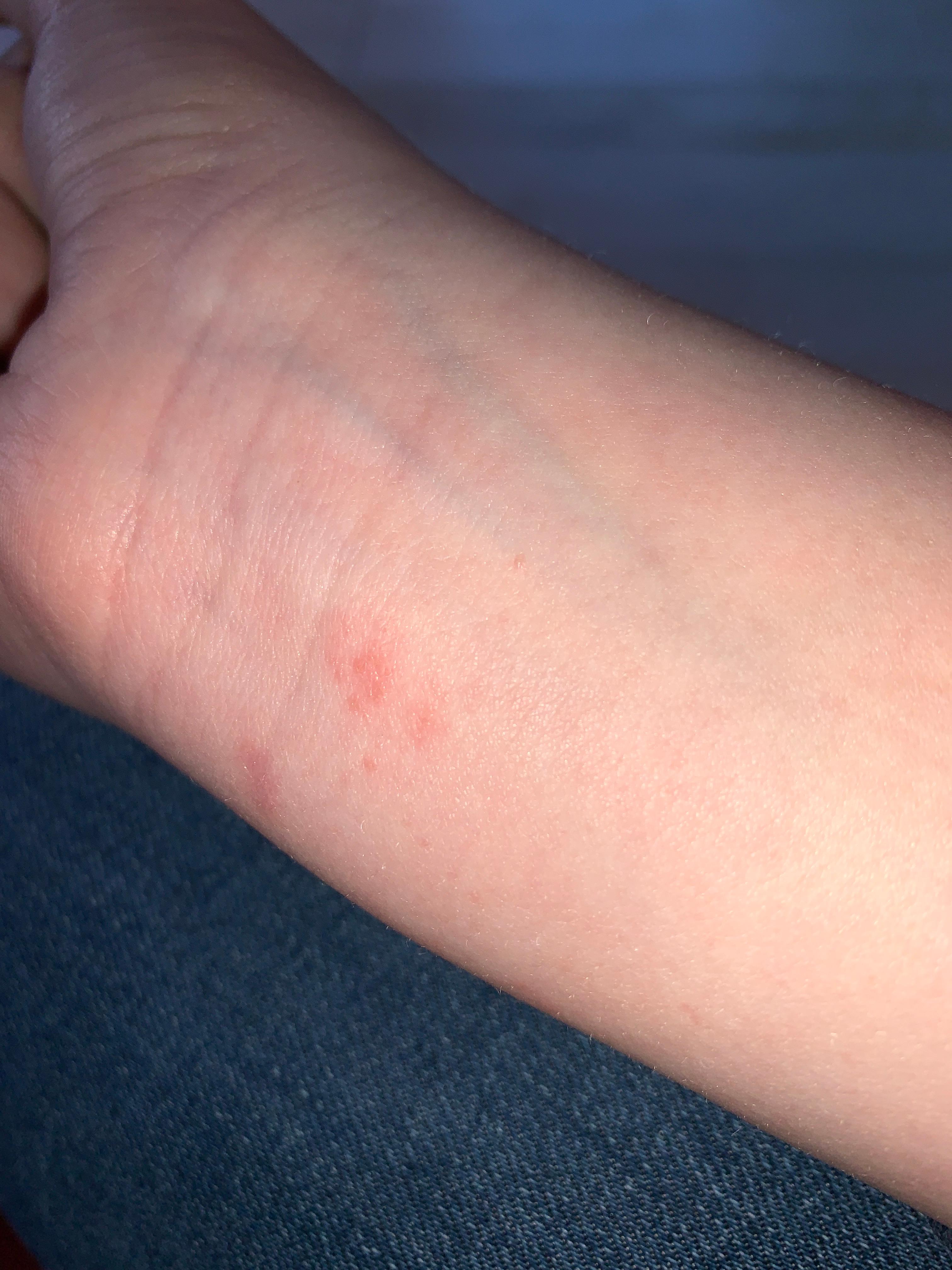 Gurtelrose Kleiner Ausschlag Juckreiz Gurtelrose Kleiner Ausschlag Juckreiz