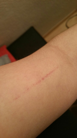 Was ist das für ein roter Strich auf meiner Haut?