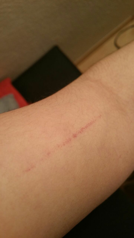 Was Ist Das Fur Ein Roter Strich Auf Meiner Haut Verletzung Was Ist Das Fur Ein Roter Strich Auf Meiner Haut Verletzung