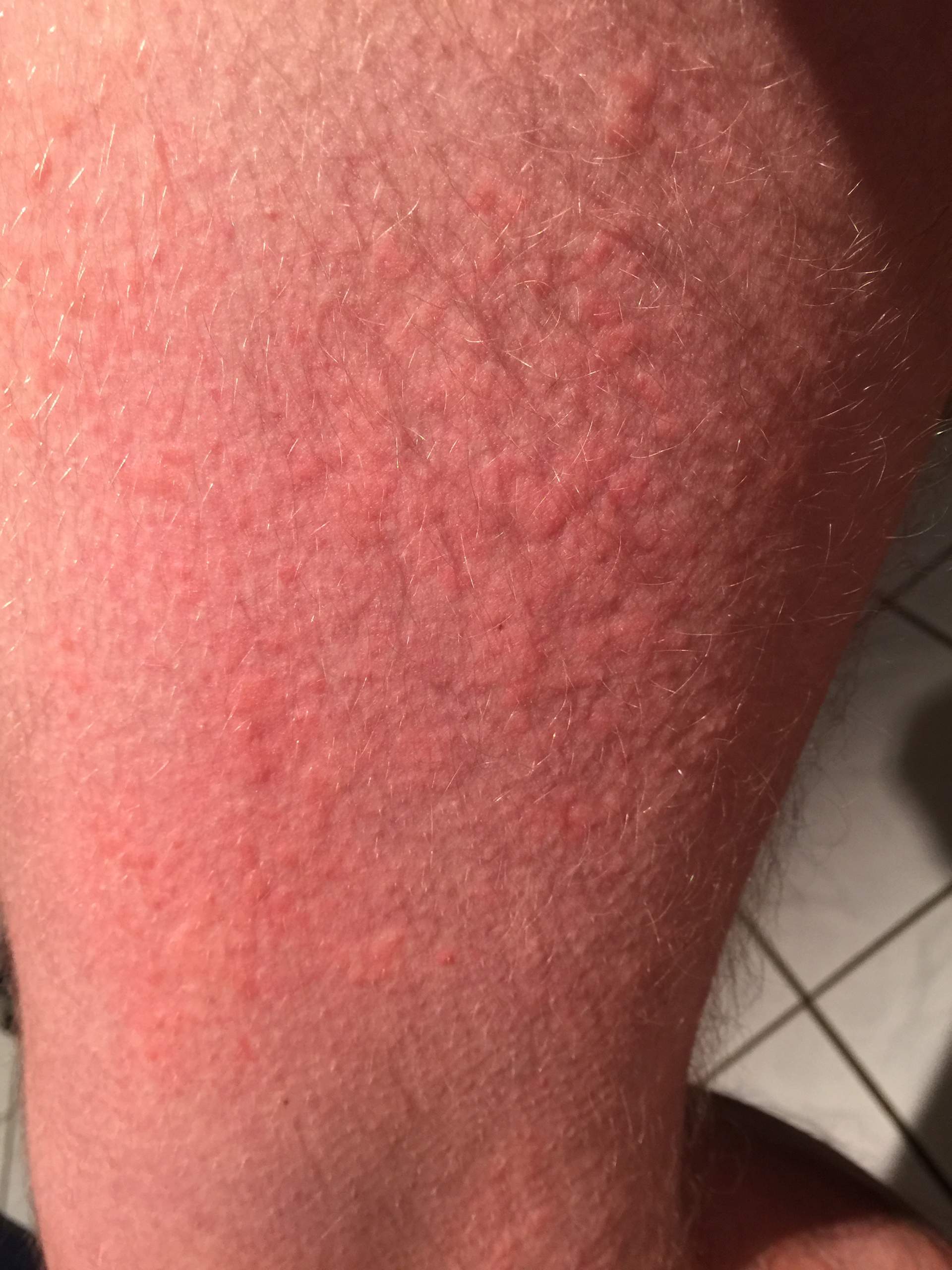 Ist dieser Ausschlag ein Fall für den Arzt? (Hautausschlag)