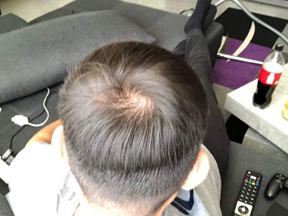 Haarausfall oder Haarwirbel?