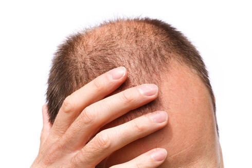 Haare - (Haarausfall, Kopfhaut, Chirurgie)