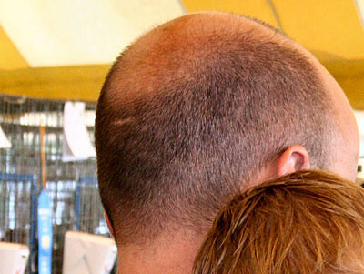 Haarausfall - (Haarausfall, Kopfhaut, Chirurgie)