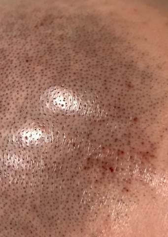 Hab Mich Beim Haare Rasieren An Der Haut Geschnitten Werden Die Haare An Dieser Stelle Nicht Mehr Nachwachsen Gesundheit Haarausfall Gesundheit Und Medizin