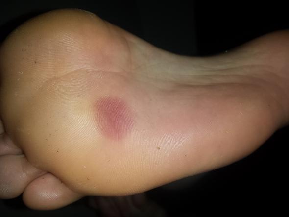 blauer fleck am fuß