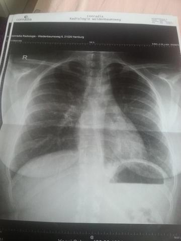 Habe ich eine Lungenentzündung mit Röntgenbild