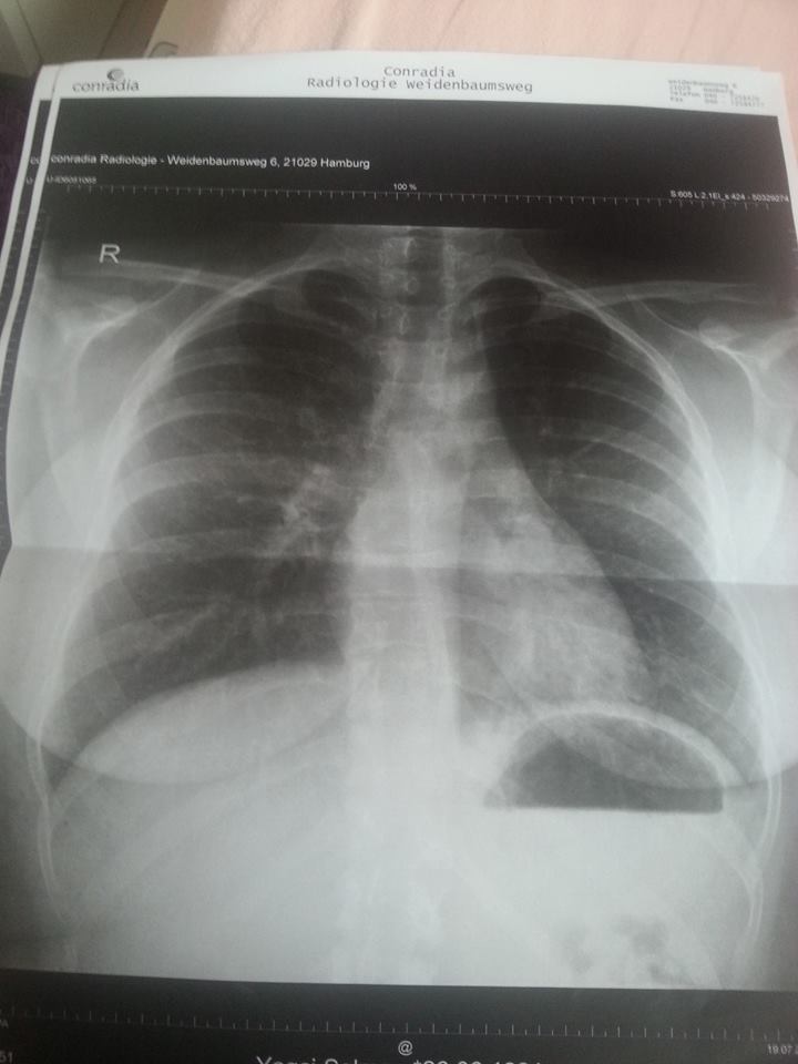 Habe ich eine Lungenentzündung mit Röntgenbild (Entzündung, Husten, Lunge)