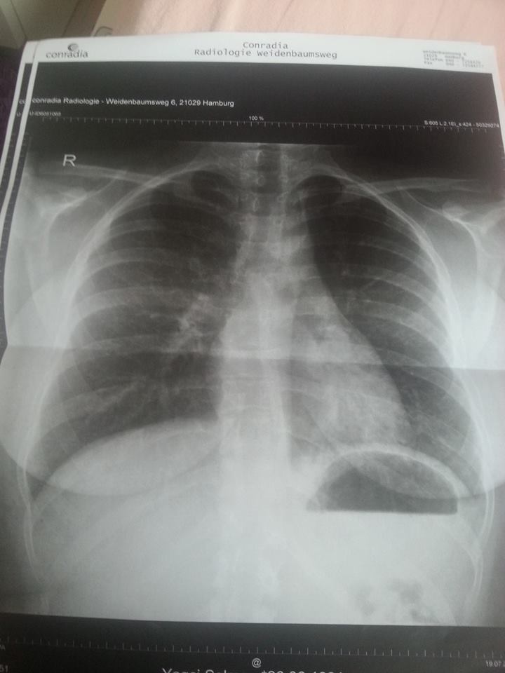 Schönen mittwochabend bilder -seite 2- zum verschicken & teilen Habe ich eine Lungenentzündung mit Röntgenbild (Entzündung, Husten, Lunge)