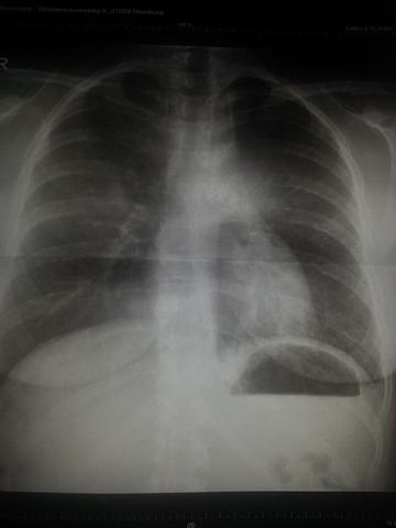 Röntgenbild 2 - (Entzündung, Husten, Lunge)