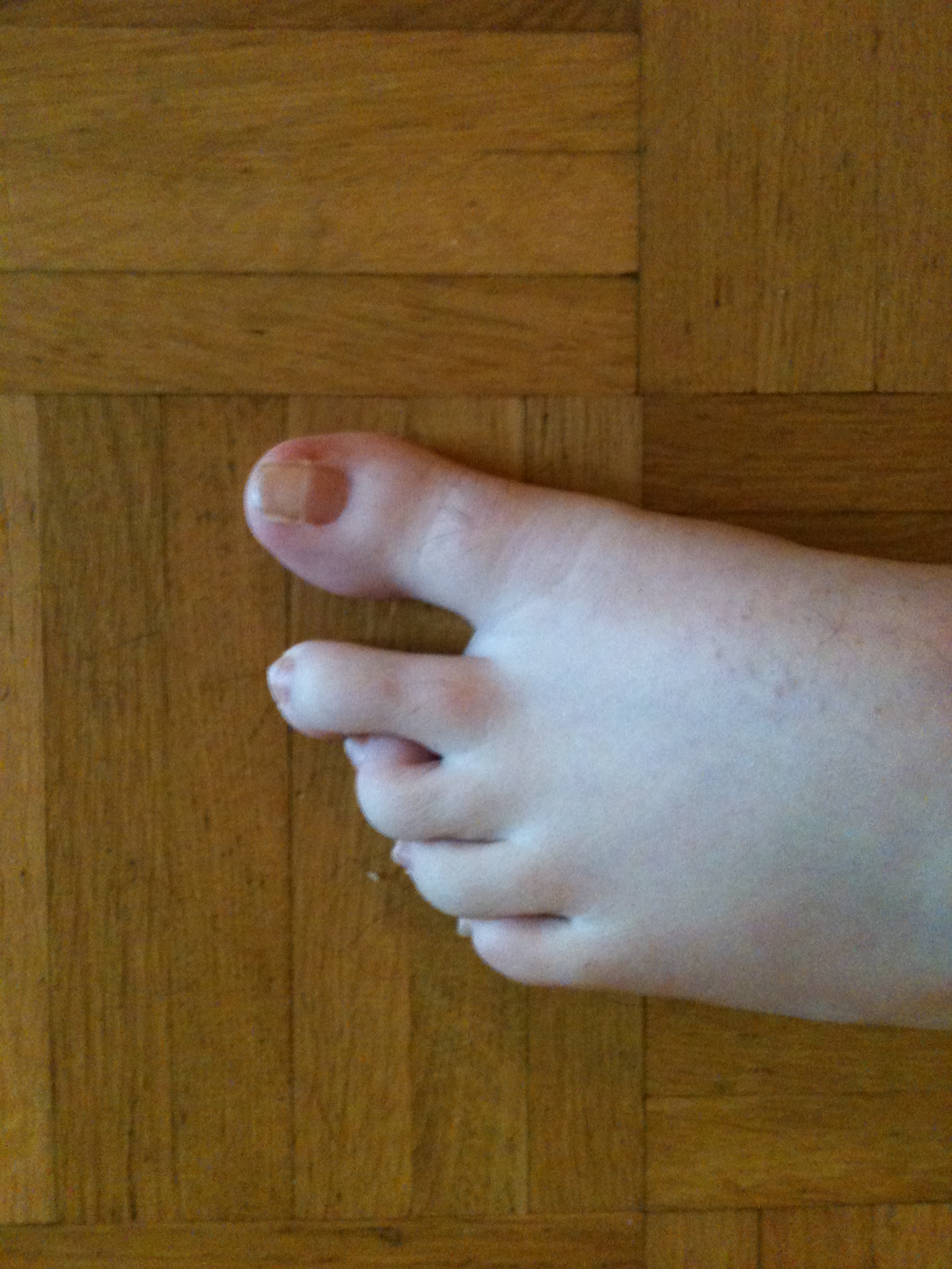 Habe ich einen “Hammerzeh” und was muss ich da tun? (Orthopädie)