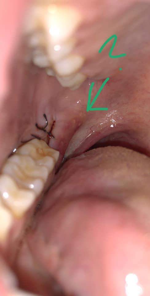 habe ich nach meiner Weisheitszahn op eine entzündung? (Gesundheit, Operation, Weisheitszähne)
