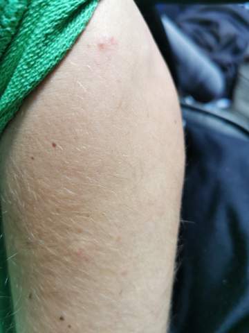 - (Haut, Dermatologie, Schuppenflechte)