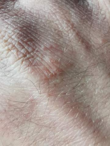 - (Haut, Dermatologie, Schuppenflechte)