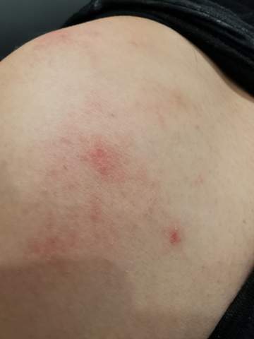 - (Haut, Dermatologie, Schuppenflechte)