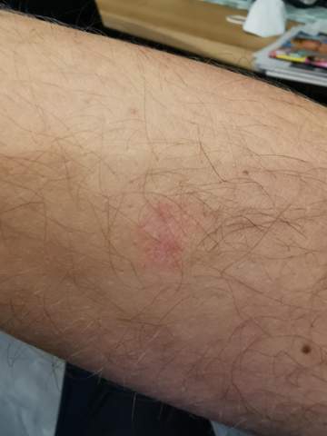 - (Haut, Dermatologie, Schuppenflechte)