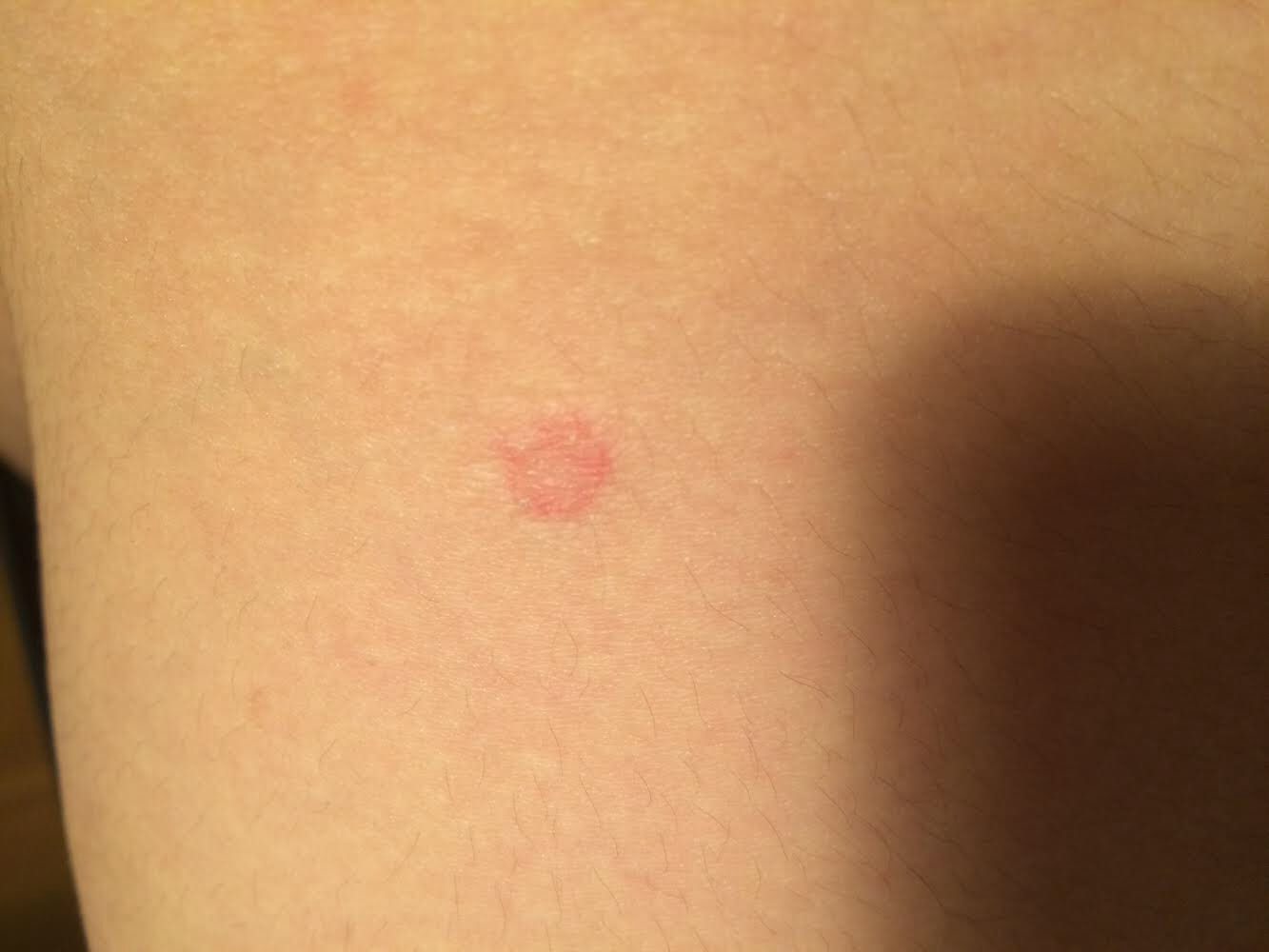 Rabbit nose swollen rabbits syphilis sore upwards sticks lips normal Habe ich Syphilis? (Symptome)