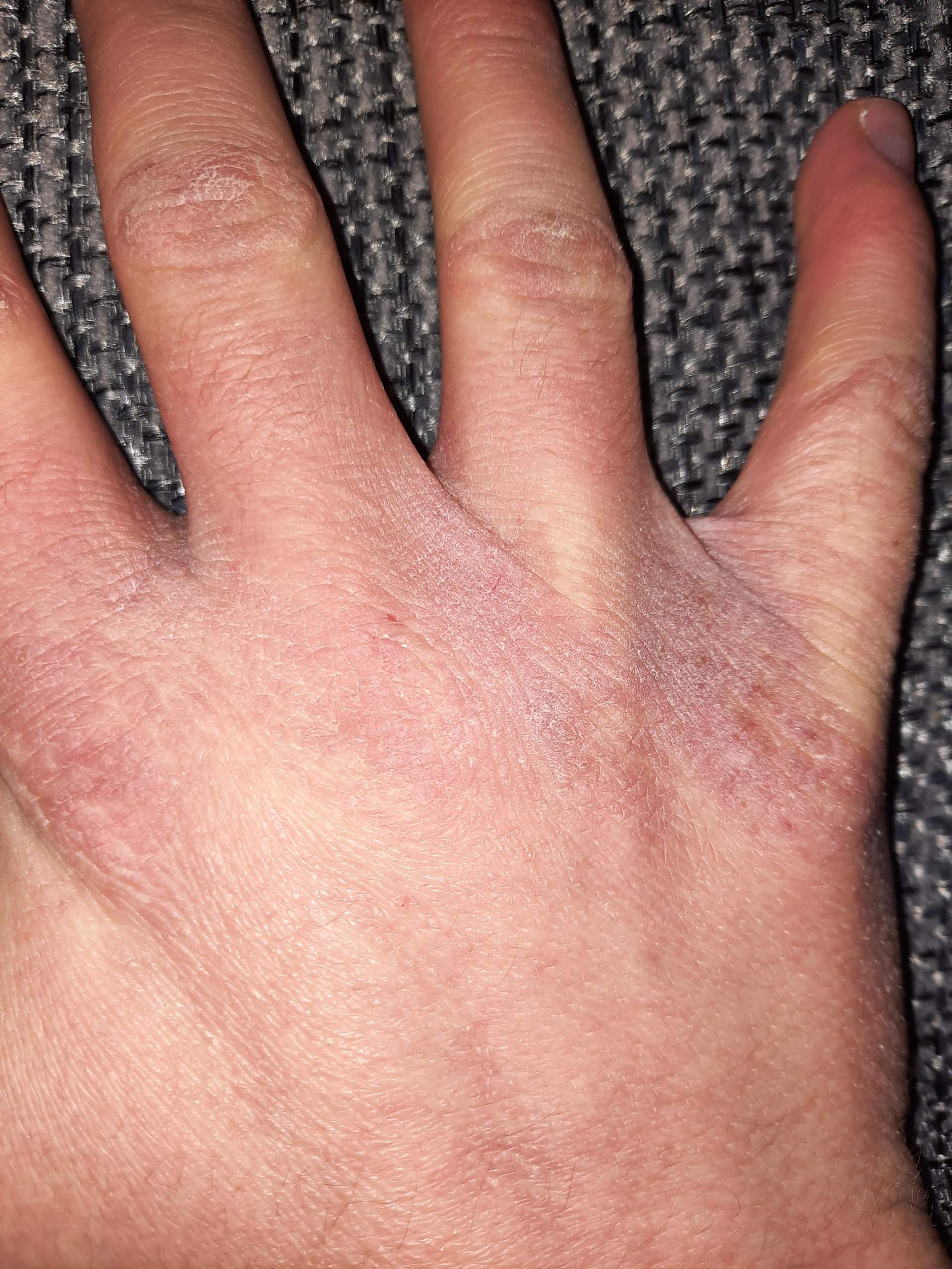 Hände trocken oder andere Ursache? (Haut, Hand)