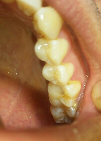 Bild 1  - (Zähne, Zahnarzt, Karies)