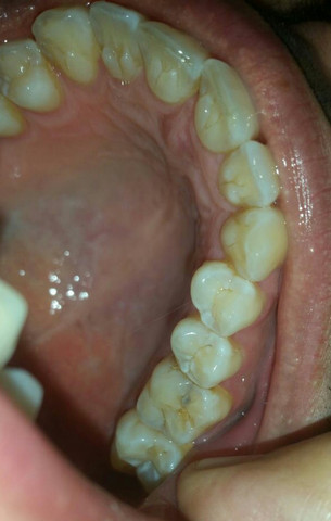 Bild 2 - (Zähne, Zahnarzt, Karies)