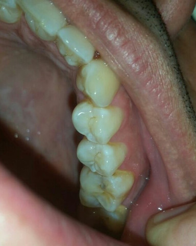 Bild 3 - (Zähne, Zahnarzt, Karies)