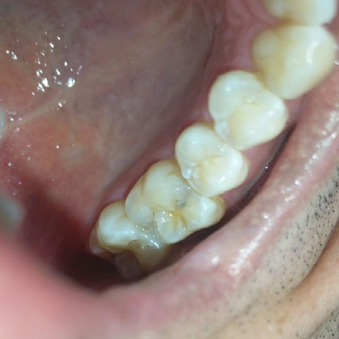 Bild 4 - (Zähne, Zahnarzt, Karies)