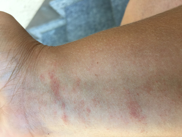 Hallo ihr lieben, war bereits beim HA, der hat Blut abgenommen weil er Hallo ihr lieben, war bereits beim HA, der hat Blut abgenommen weil er