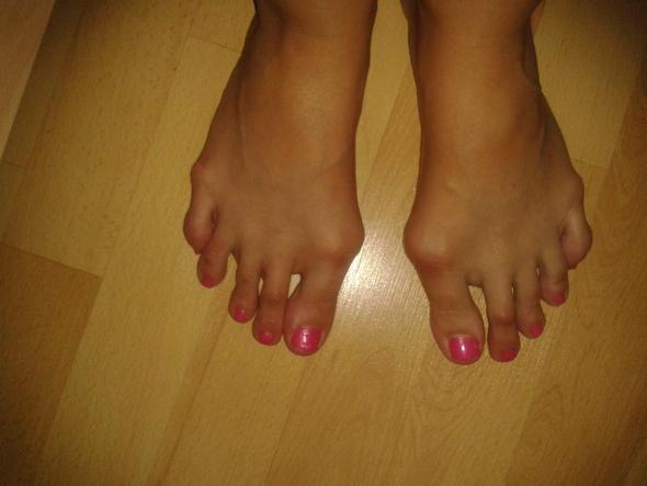 Hallux Valgus Schon Seit Der Kindheit Kinder Fusse Hallux Valgus Schon Seit Der Kindheit Kinder Fusse