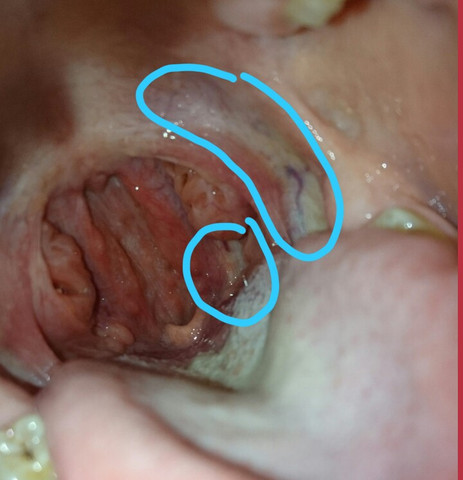 Mein momentaner Mundraum. Stellen sind markiert.  - (Hals, HNO, Halsschmerzen)