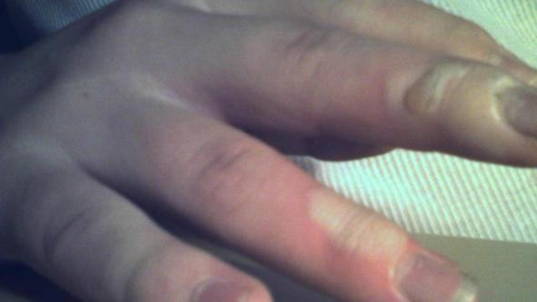 Hand Verbrannt Bei Heissem Ol Bild Verbrennung Hand Verbrannt Bei Heissem Ol Bild Verbrennung