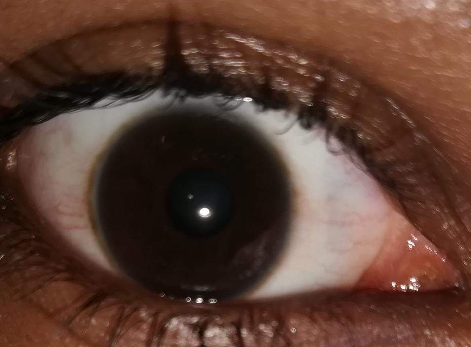 Hat jemand eine Idee was das für Ringe um die Iris sein könnten? (Gesundheit, Augen)