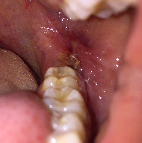 Wunde unten links - (Zähne, Entzündung, Weisheitszähne)