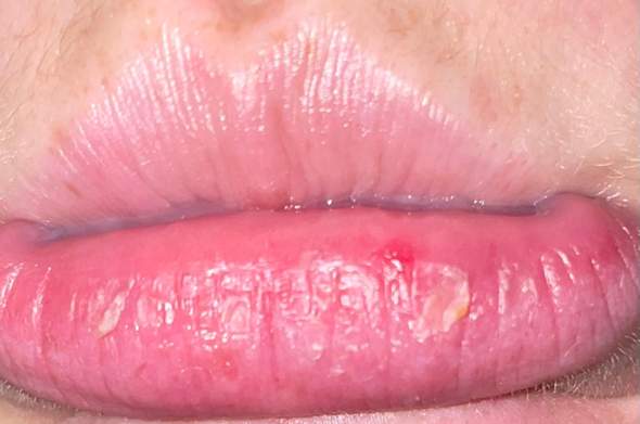  - (Lippe, Herpes)