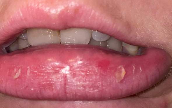  - (Lippe, Herpes)