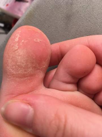 Haut am Fuß löst sich?