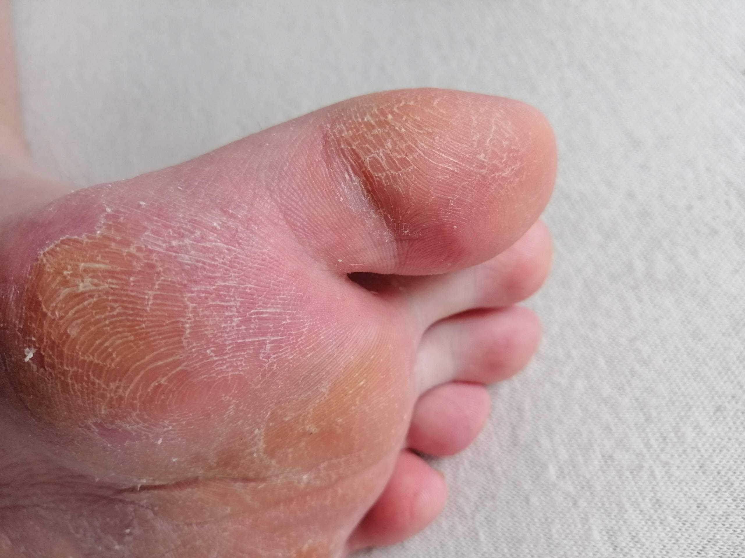 Haut am Fuß schuppt und pellt sich etwas (nach Fraktur)? (Fußpilz)