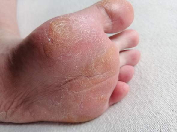 Haut am Fuß schuppt und pellt sich etwas (nach Fraktur)? (Fußpilz)