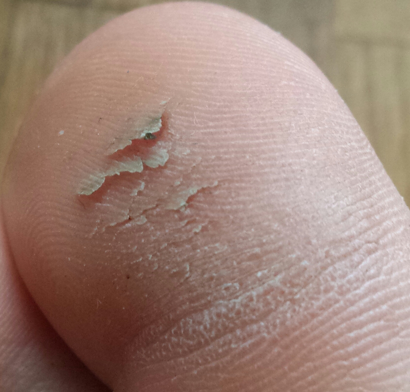 Haut Löst Sich Von Eichel Captions Trendy Haut Löst Sich Von Eichel Captions Trendy