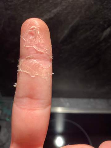 Haut an einem Finger geht ab?