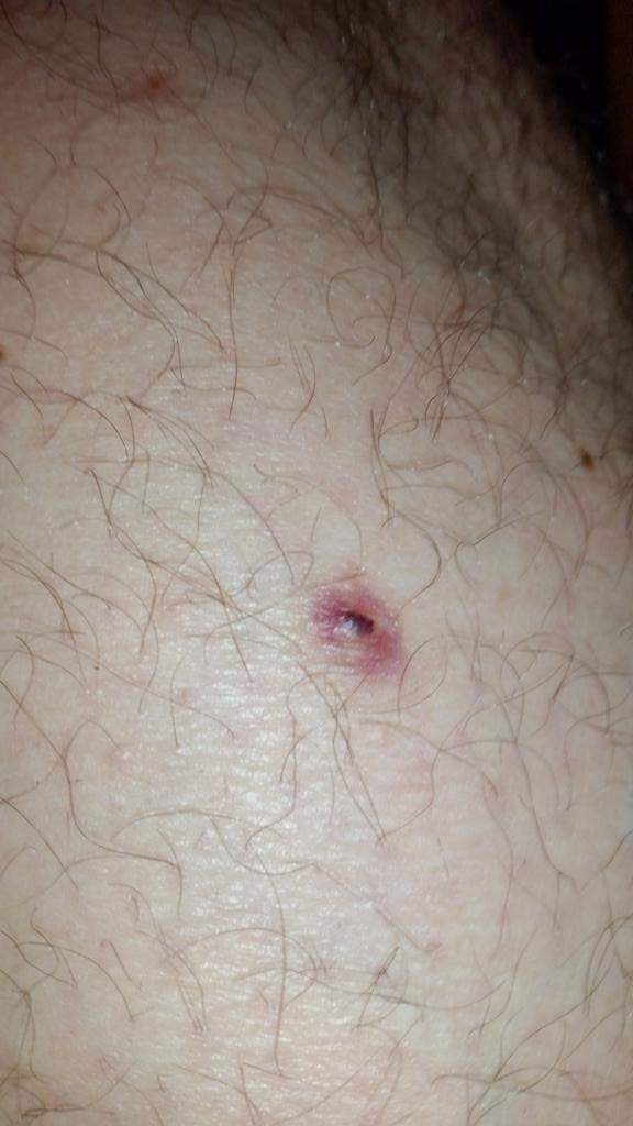 Haut: schwarzer Punkt, der verschwindet und wiederkommt? (Dermatologie