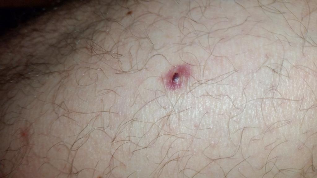 Haut: schwarzer Punkt, der verschwindet und wiederkommt? (Dermatologie