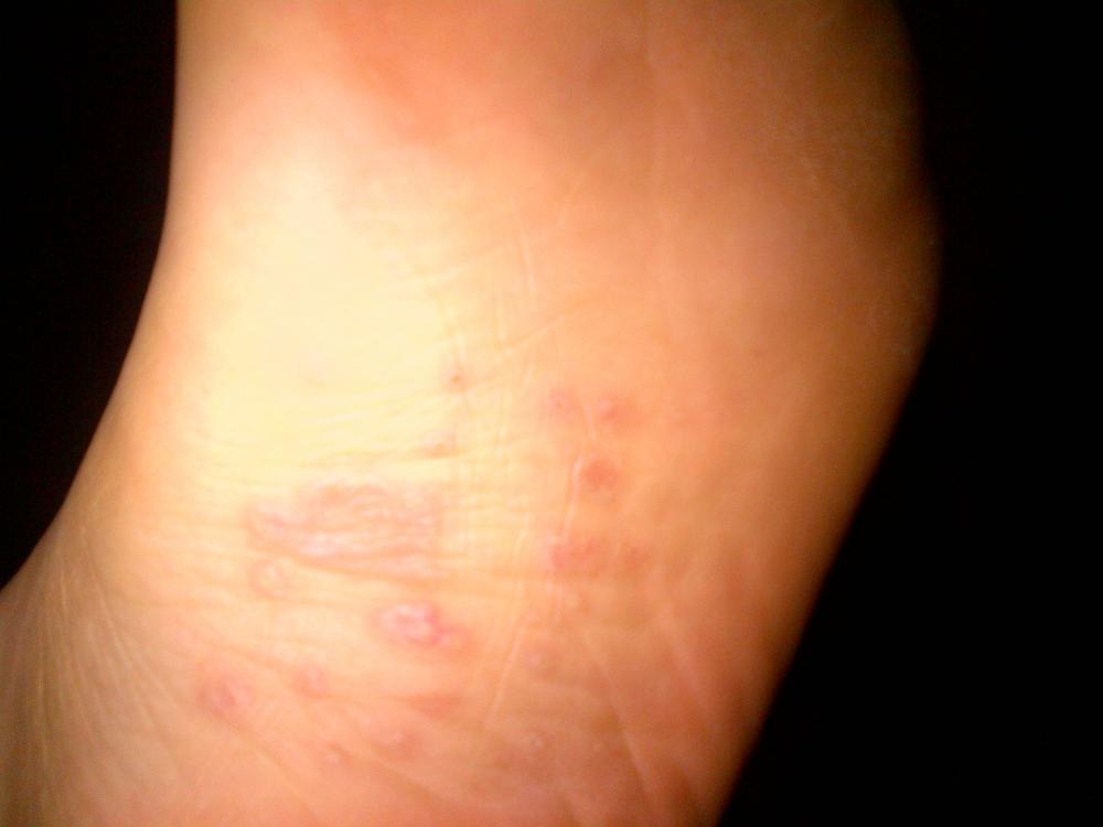 Hautausschlag am Fuß (Füße, Ausschlag, Dermatologie)