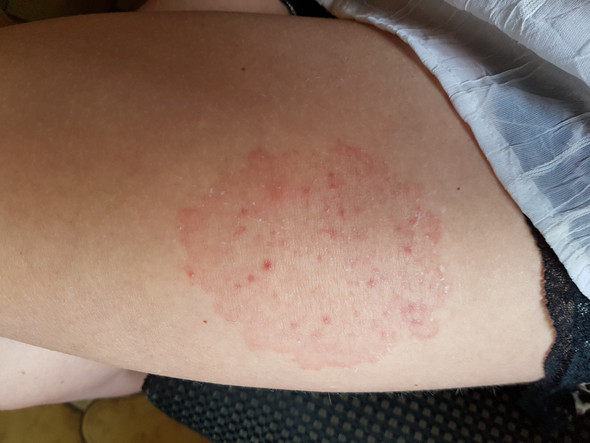 Hautausschlag Am Oberschenkel Haut Dermatologie Hautausschlag Am Oberschenkel Haut Dermatologie