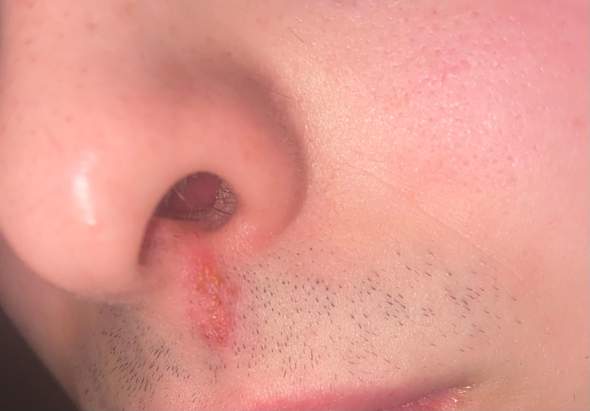 Hautausschlag An Der Nase Ausschlag Hautausschlag An Der Nase Ausschlag