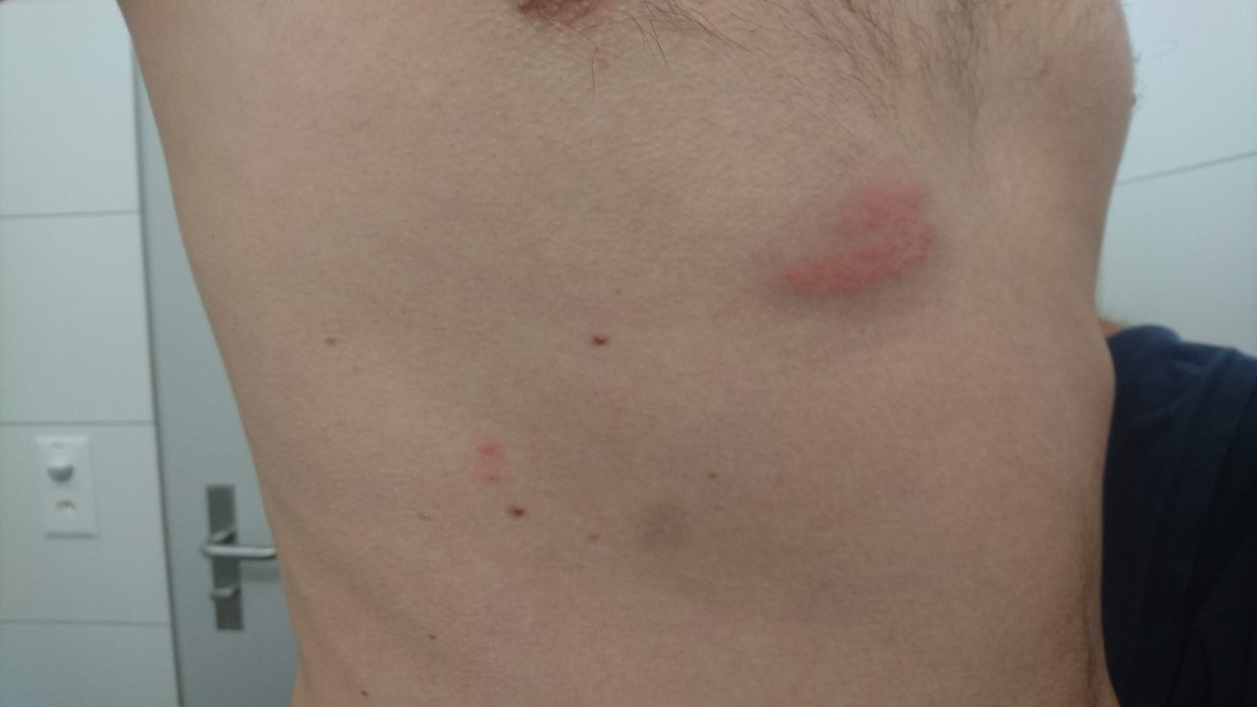 36+ Hautausschlag unter der brust bilder , Hautausschlag unter Brust, Seite, Rücken? (Haut, Ausschlag)