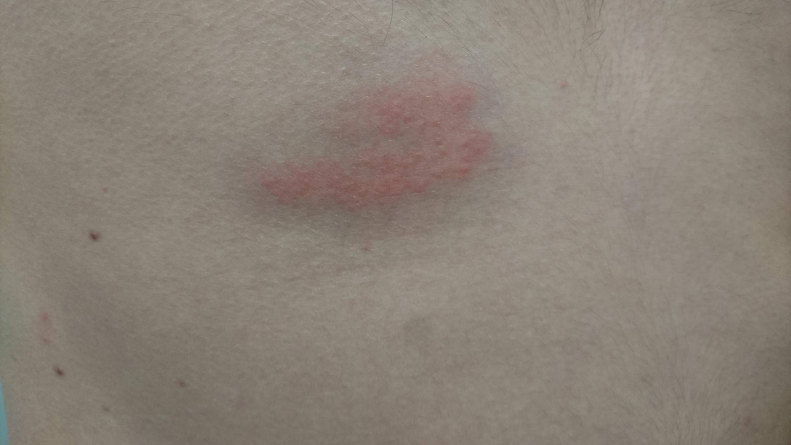 Hautausschlag unter Brust, Seite, Rücken? (Haut, Ausschlag)