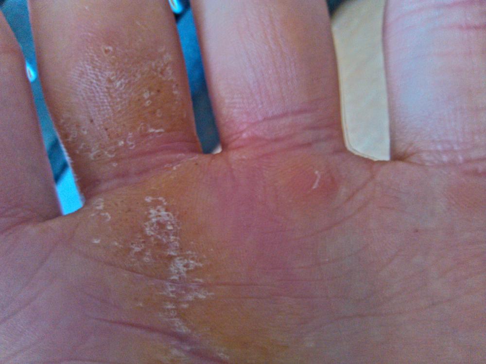 Haut/Hornhaut aufgekratzt an der Hand + schwarze Punkte?