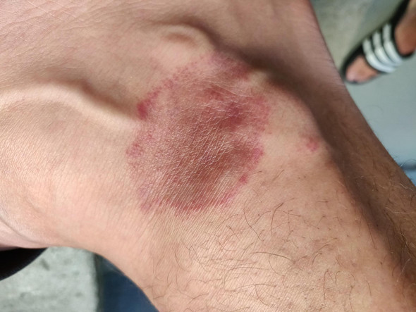 Luxus Hautkrankheiten Rote Flecken Am Bein Diabetes Luxus Hautkrankheiten Rote Flecken Am Bein Diabetes