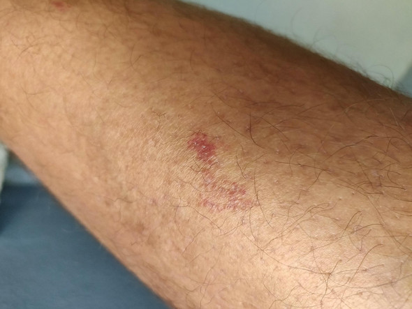 rote flecken am bein diabetes bilder rote flecken am bein diabetes bilder