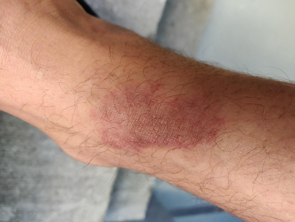 Hautkrankheit, rote Flecken am Bein? (Hautprobleme, Schuppenflechte ...