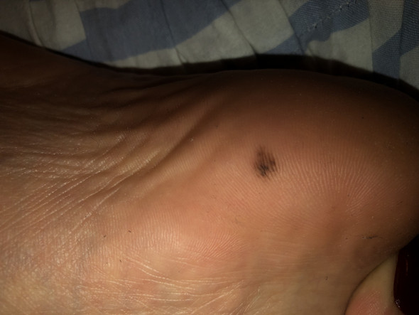 Fußsohle muttermal ABCDE